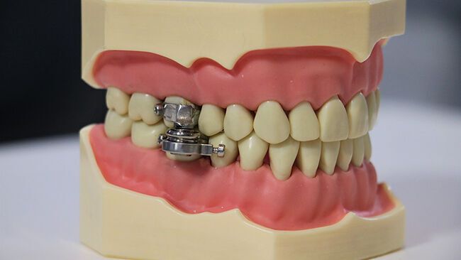 Magnetic dentures: the controversial invention for weight loss

