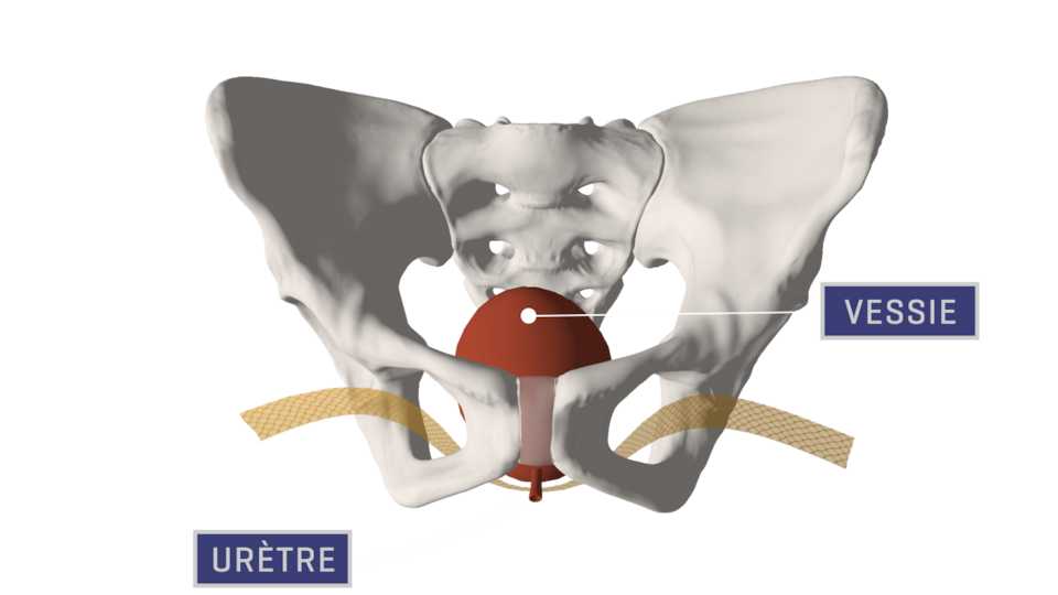 Representation of the pelvis and a tape supporting the bladder.