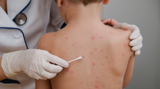 Chickenpox and shingles, one virus for two different diseases

