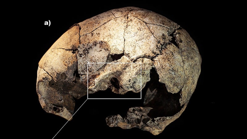 5,300-year-old skull and ear surgery marks
