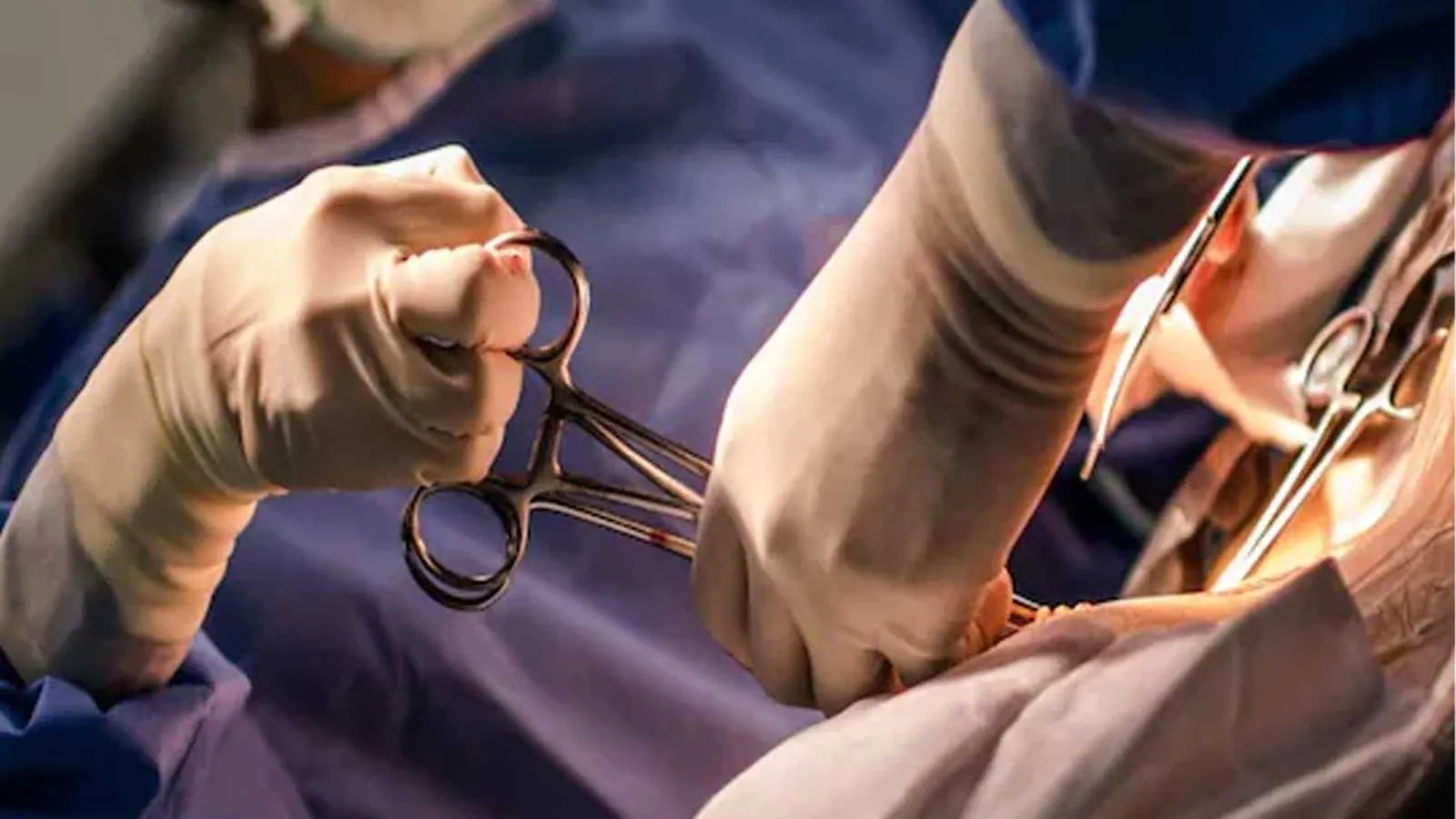 Une femme malaisienne développe une corne de 5 cm sur sa poitrine et la fait retirer par chirurgie