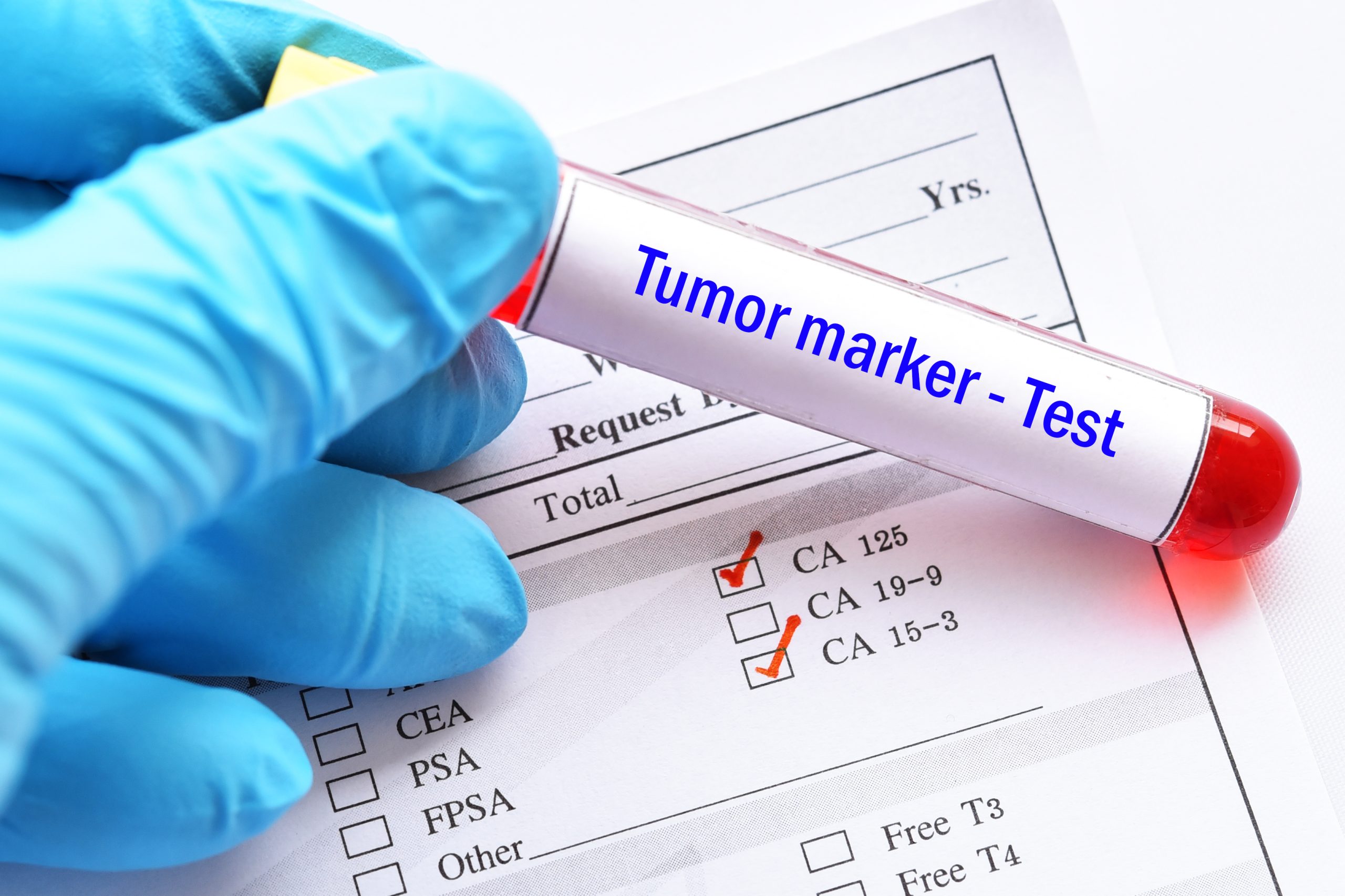 Prostate cancer: for targeted screening based on patient risk

