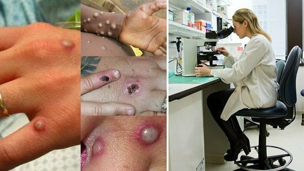 RTL Today - Weekly update: Five new cases of monkeypox in Luxembourg

