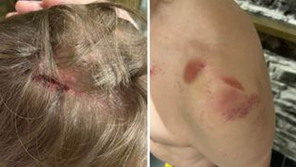 Two images of injuries: a cracked, bloody skull, and one shoulder bruise.